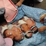 染色体易位在镇江市妇幼保健院可以做三代试管吗？染色体平衡易位还能生健康的宝宝吗？